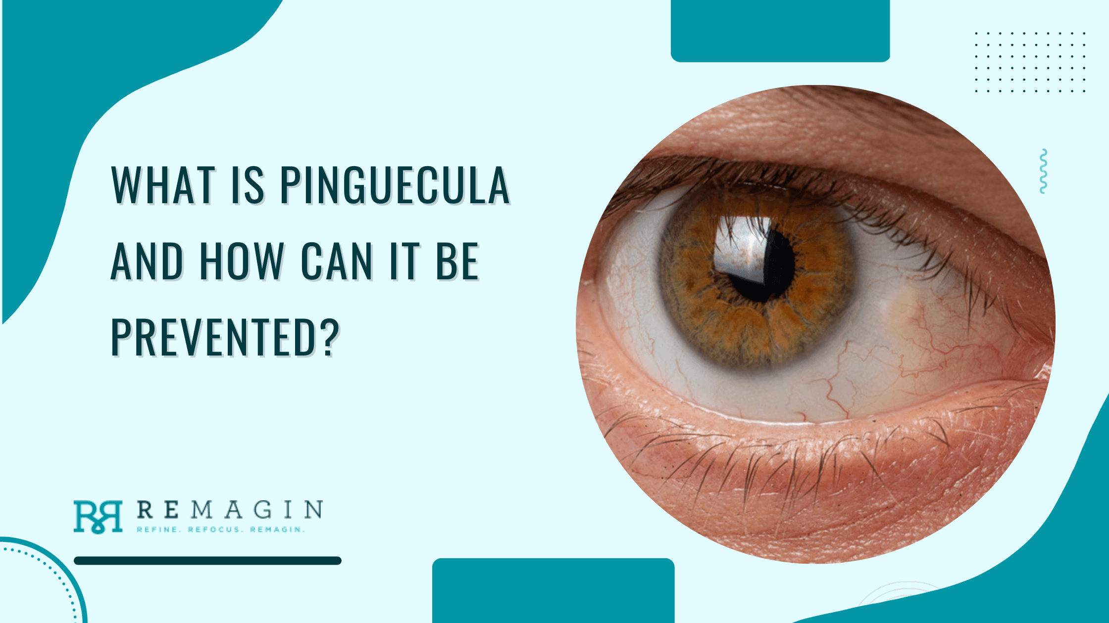 What Is Pinguecula and How Can It Be Prevented?