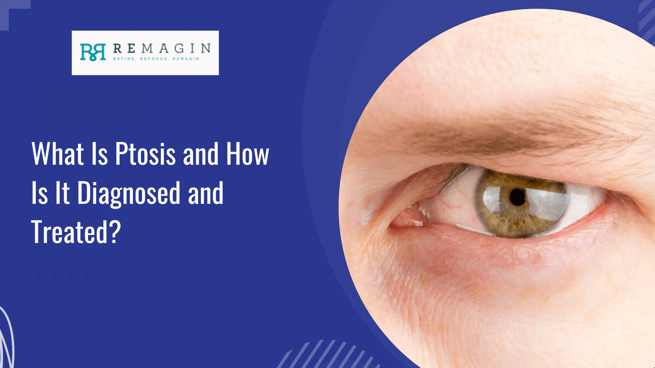 What Is Ptosis and How Is It Diagnosed and Treated?