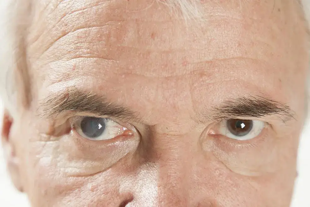 7 Signs You Might Have Cataracts