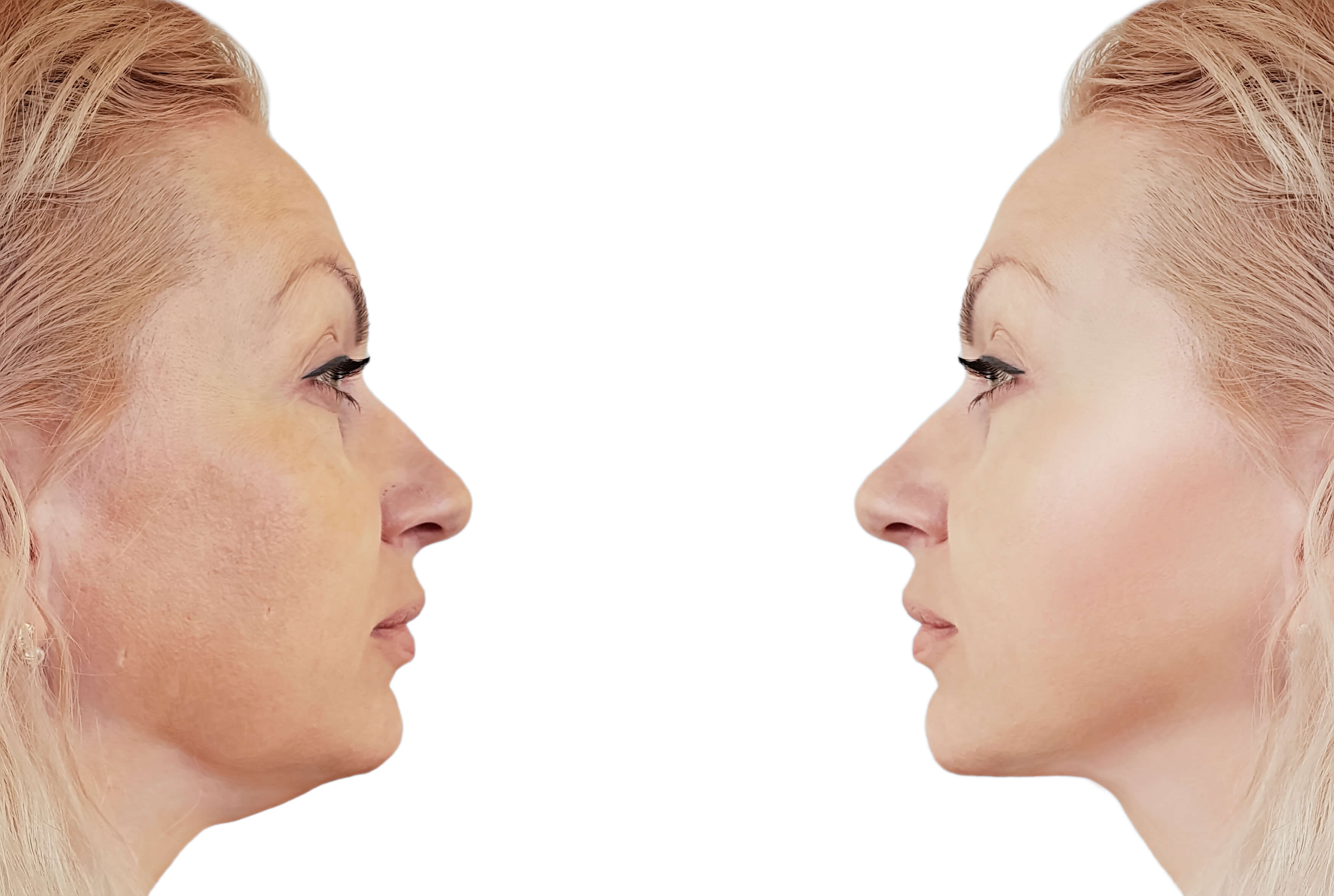 Kybella: A Non-Invasive Way to Achieve a More Defined Chin