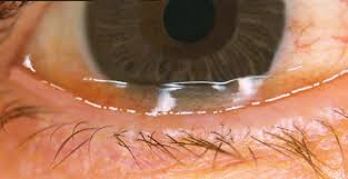 Eyelid Muscles