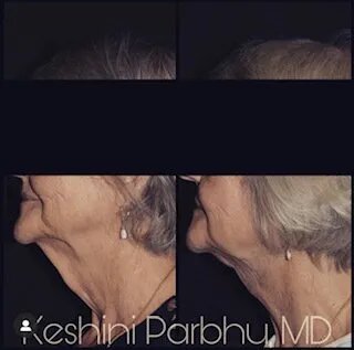 facial-contouring