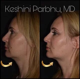 facial-contouring