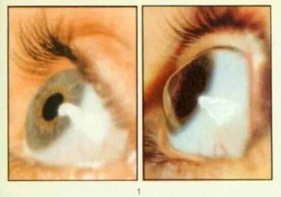 Recurrent erosion syndrome
