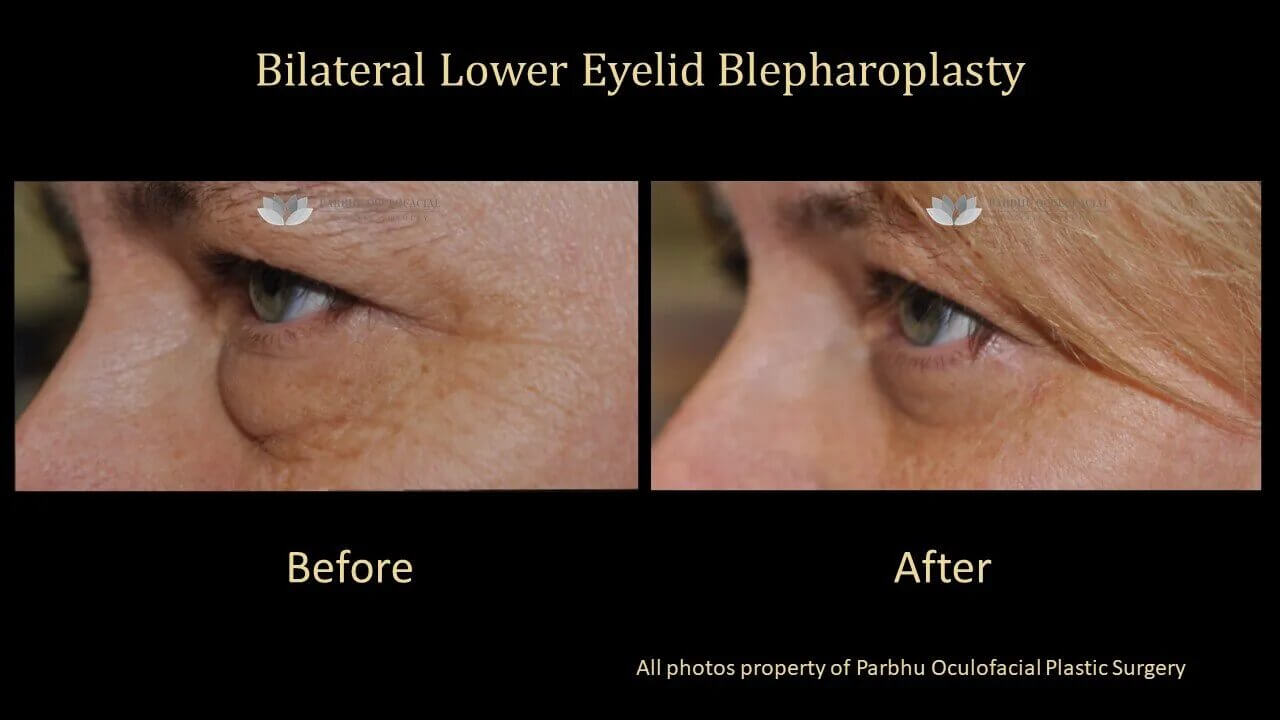 Lower EyelidBrowSurgery