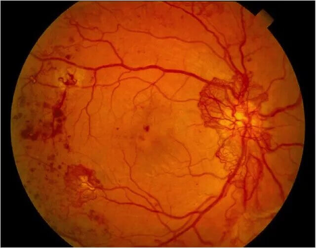 corneal-abrasion