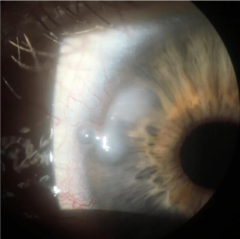 Recurrent erosion syndrome