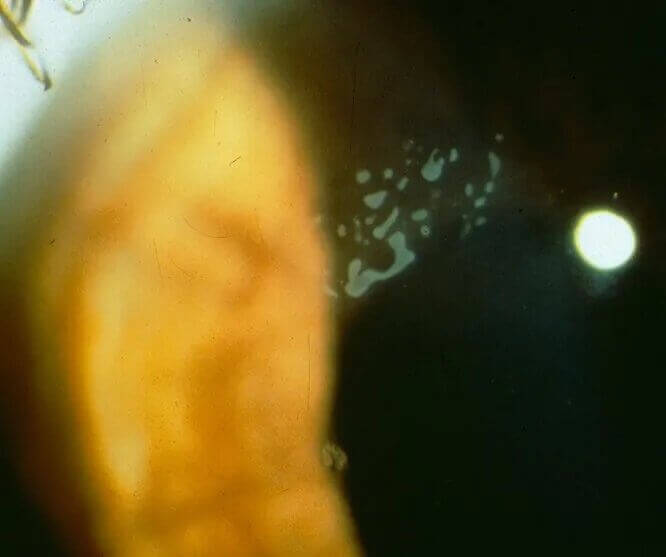 Recurrent erosion syndrome