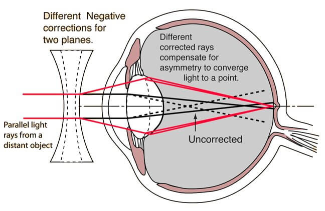 astigmatism