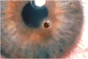 Corneal Foreign Body