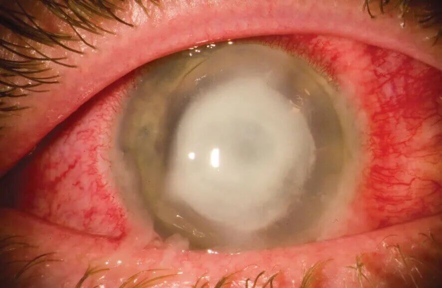 corneal-ulcer
