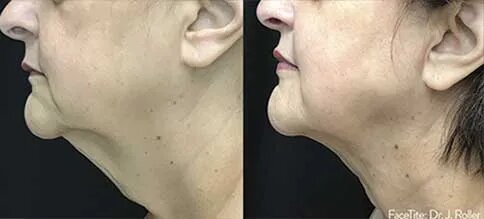 facial-contouring