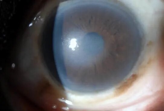 Keratoconus