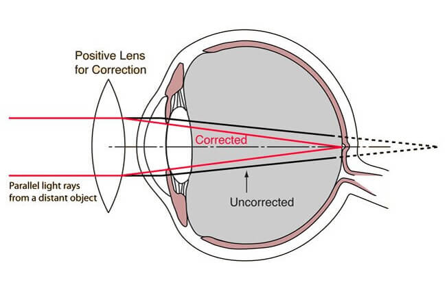 hyperopia