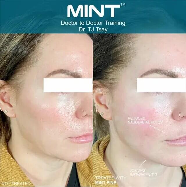 MINT™ PDO