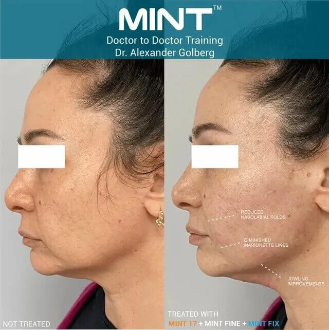 MINT™ PDO