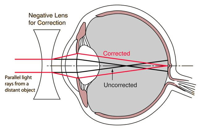 myopia