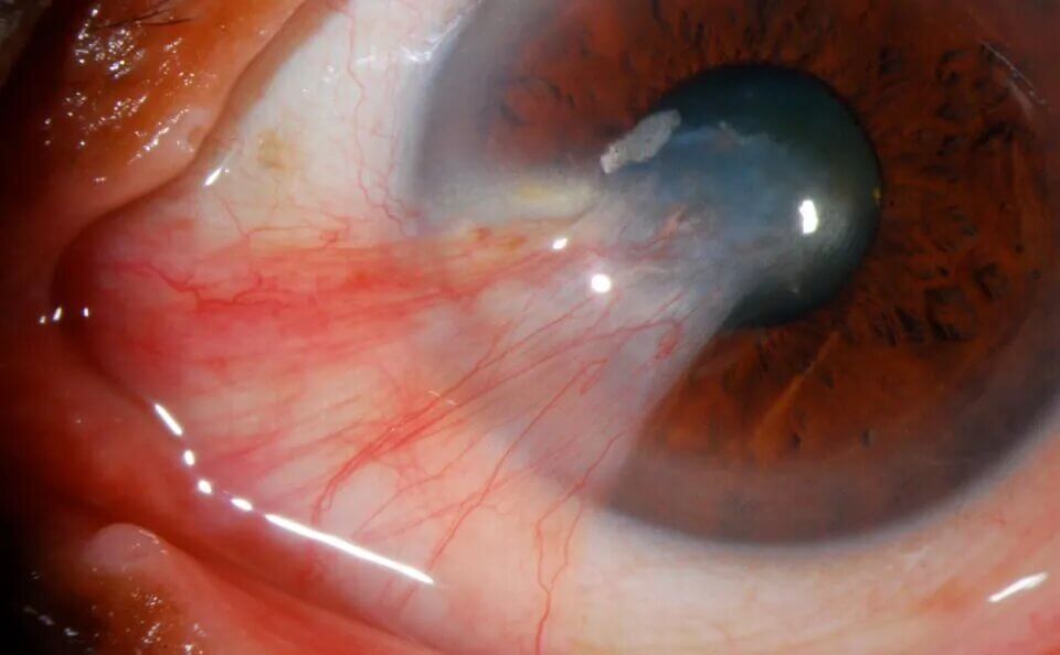 Pterygium